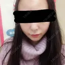 脂肪吸引（顔） / その他（輪郭） / 脂肪注入（輪郭） ヴィヴェンシアクリニック DAY 60 サムネイル用