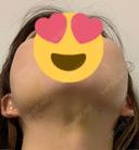 脂肪吸引（顔） パールスキンクリニック天神 DAY 10 サムネイル用