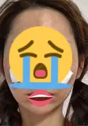 糸リフト / 水光注射（ハリ・美肌） / ヒアルロン酸注入（あご） / ハイフ（顔） 品川スキンクリニック表参道院 DAY 10 サムネイル用