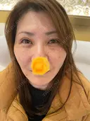 二重埋没 / 糸リフト / バッカルファット除去 / 脂肪吸引（顔） / ヒアルロン酸注入（鼻） / ヒアルロン酸注入（あご） / ヒアルロン酸注入（頬） 東京ミッドクリニック AFTER サムネイル用
