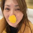 二重埋没 / 糸リフト / バッカルファット除去 / 脂肪吸引（顔） / ヒアルロン酸注入（鼻） / ヒアルロン酸注入（あご） / ヒアルロン酸注入（頬） 東京ミッドクリニック DAY 67 サムネイル用
