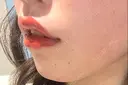 ヒアルロン酸注入（唇） / ボトックス（口角） レナトゥスクリニック 東京田町院 DAY 0 サムネイル用