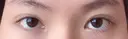 二重切開 / 目頭切開 / 上まぶたの脂肪取り 樹のひかり 形成外科・皮ふ科 DAY 271 サムネイル用