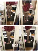 脂肪吸引（脚） / 脂肪吸引（お尻） ヨンセスリムライン DAY 45 サムネイル用