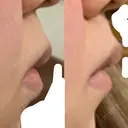 ボトックス（口角） / その他（口元） 表参道スキンクリニック 名古屋院（DAILY SKIN CLINIC提携院） DAY 2 サムネイル用