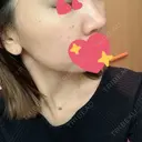 イオン導入 / フォトRF 湘南美容クリニック 表参道院 DAY 0 サムネイル用