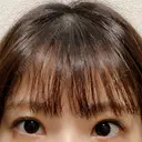 二重切開 こまちクリニック AFTER サムネイル用