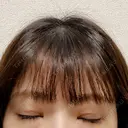 二重切開 こまちクリニック DAY 31 サムネイル用