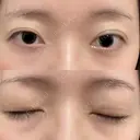 二重切開 松下皮フ形成外科 AFTER サムネイル用