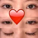 二重埋没 / 目頭切開 / 眼瞼下垂（切開） / 目尻切開 グロービー美容整形外科 AFTER サムネイル用
