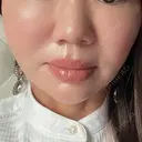 糸リフト X CLINIC 銀座院 AFTER サムネイル用