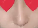 隆鼻術 / 鼻尖形成（切開） / 小鼻縮小（切開） / ほくろ・いぼ切除（肌） / 鼻翼挙上 東京形成美容外科 船橋院 DAY 273 サムネイル用