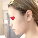 ヒアルロン酸注入（鼻） / ボトックス（あご） / ヒアルロン酸注入（あご） アクトリー勝どきウェルネスメディカルクリニック DAY 1 サムネイル用