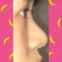 鼻尖形成（切開） / 小鼻縮小（切開） / 軟骨移植 / 鼻孔縁挙上 / 鼻尖縮小 ヴェリテクリニック 大阪院 DAY 61 サムネイル用