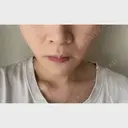 バッカルファット除去 / 脂肪吸引（顔） EMMA CLINIC（エマクリニック） AFTER サムネイル用
