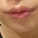 小鼻縮小（切開） / 口唇縮小術 / 口角挙上 / その他（鼻） / その他（口元） B-LINE CLINIC 池袋院 DAY 64 サムネイル用