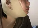 鼻尖形成（切開） / 軟骨移植 あつぎ美容クリニック AFTER サムネイル用