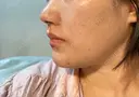 鼻尖形成（切開） / 軟骨移植 あつぎ美容クリニック DAY 70 サムネイル用