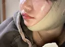 鼻尖形成（切開） / 軟骨移植 あつぎ美容クリニック DAY 70 サムネイル用