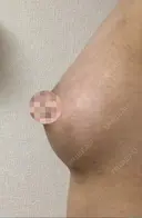 脂肪吸引（お腹） / 脂肪吸引（お尻） / 豊胸（脂肪注入） / その他（ボディ） ドクターフィット（Dr.fit）クリニック DAY 29 サムネイル用