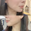 ヒアルロン酸注入（あご） 東京イセアクリニック DAY 1 サムネイル用