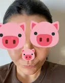 脂肪吸引（顔） / 切開リフト / ヒアルロン酸注入（ほうれい線） 東京エビスクリニック DAY 310 サムネイル用
