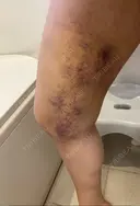脂肪吸引（脚） 湘南美容クリニック 新潟院 DAY 8 サムネイル用