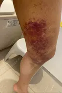脂肪吸引（脚） 湘南美容クリニック 新潟院 DAY 8 サムネイル用