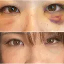 クマ治療 / 下まぶたの脂肪取り / 脂肪注入（肌） X CLINIC 大阪院 DAY 5 サムネイル用