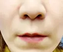 人中短縮 / 鼻翼基部形成（貴族手術） / その他（口元） eクリニック 金沢本院 DAY 21 サムネイル用