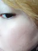 シミ取りレーザー PICO BEAUTY CLINIC DAY 4 サムネイル用