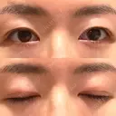 二重切開 城本クリニック 長崎院 DAY 72 サムネイル用