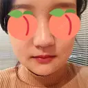 骨切り（あご） / 骨削り（エラ） / ルフォー+ssro（両あご) リラ・クラニオフェイシャル・クリニック DAY 16 サムネイル用