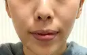人中短縮 / その他（口元） eクリニック 金沢本院 AFTER サムネイル用