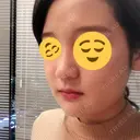 骨切り（あご） / 骨削り（エラ） / ルフォー+ssro（両あご) リラ・クラニオフェイシャル・クリニック DAY 16 サムネイル用