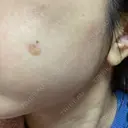 シミ取りレーザー / 光治療（フォトフェイシャルなど） 東京ミッドクリニック DAY 3 サムネイル用