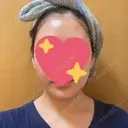 糸リフト / 脂肪吸引（顔） eクリニック 金沢本院 DAY 11 サムネイル用