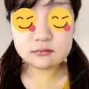 骨切り（あご） / 骨削り（エラ） / ルフォー+ssro（両あご) リラ・クラニオフェイシャル・クリニック DAY 7 サムネイル用