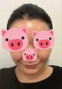 脂肪吸引（顔） / 切開リフト / ヒアルロン酸注入（ほうれい線） 東京エビスクリニック DAY 323 サムネイル用