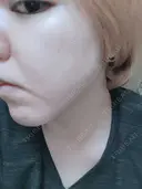 シミ取りレーザー PICO BEAUTY CLINIC DAY 5 サムネイル用