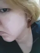 シミ取りレーザー PICO BEAUTY CLINIC DAY 7 サムネイル用