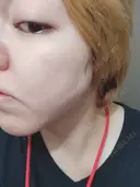 シミ取りレーザー PICO BEAUTY CLINIC DAY 9 サムネイル用
