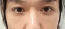 クマ治療 / 下まぶたたるみ取り / 下まぶたの脂肪取り セオリークリニック AFTER サムネイル用