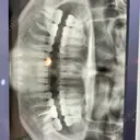 糸リフト / 骨切り（あご） / 脂肪吸引（顔） / ボトックス（エラ・小顔） 銀座マイアミ美容外科 DAY 275 サムネイル用