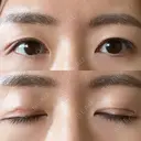 二重切開 城本クリニック 長崎院 DAY 80 サムネイル用