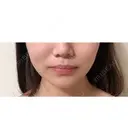 糸リフト / バッカルファット除去 / 脂肪吸引（顔） / 脂肪吸引（脚） / 脂肪吸引（お尻） / インディバ（お腹） 藤・ナチュレ美容クリニック 恵比寿院 DAY 14 サムネイル用