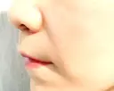 人中短縮 / 鼻翼基部形成（貴族手術） / その他（口元） eクリニック 金沢本院 DAY 30 サムネイル用