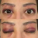 眉下切開 e:Top clinic（イートップクリニック） DAY 2 サムネイル用