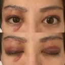 眉下切開 e:Top clinic（イートップクリニック） DAY 2 サムネイル用