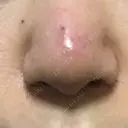 鼻尖形成（切開） / 小鼻縮小（切開） / 軟骨移植 牧野皮膚科医院 DAY 6 サムネイル用